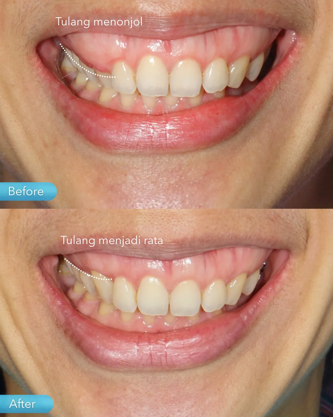 Gum surgery result
